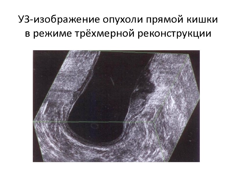 УЗ-изображение опухоли прямой кишки в режиме трёхмерной реконструкции